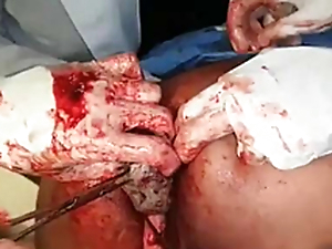 Sanitarium staff remove a stuck dildo from a man's asshole.